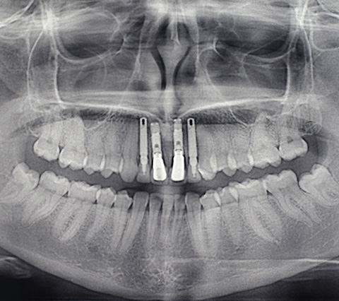 Muestra de los implantes dentales bogotá
