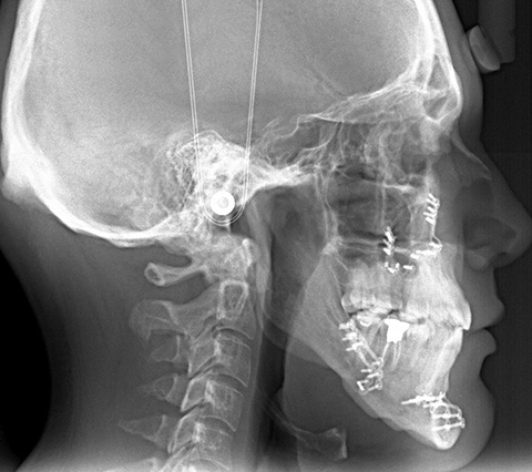 Radiografa bogot tratamiento apnea de sueo