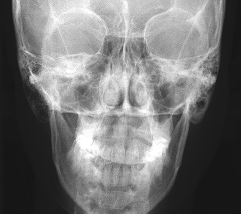 Radiografía de cirugia ortognatica en Bogotá