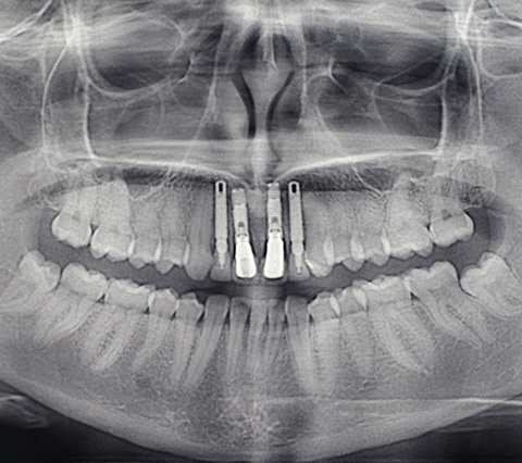 Muestra de los implantes dentales bogot